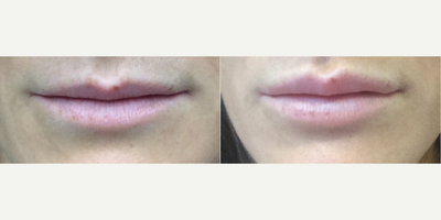 Lip Fillers before and after photo