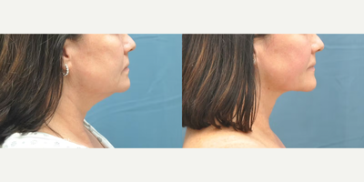 Liposuction before and after photo