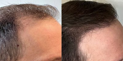 NeoGraft before and after photo