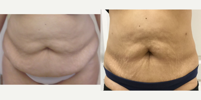 Smart Lipo before and after photo