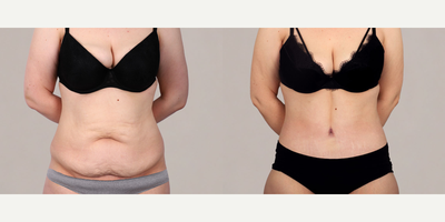 Tummy Tuck before and after photo