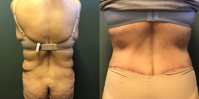 Body Lift before and after photo