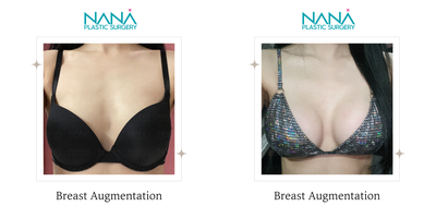 Breast Augmentation before and after photo