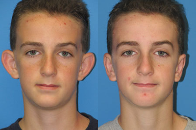 Ear Surgery before and after photo