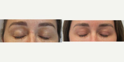 Eyelid Surgery before and after photo