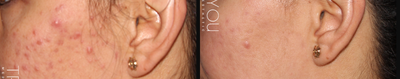 Microneedling before and after photo