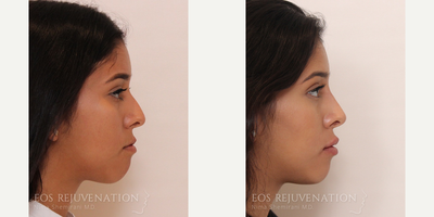 Nonsurgical Nose Job before and after photo