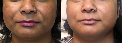 Skin Rejuvenation before and after photo
