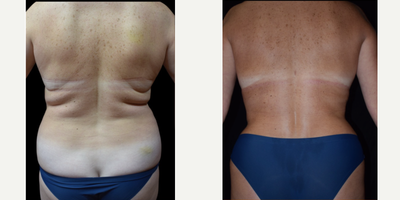 Tumescent Liposuction before and after photo