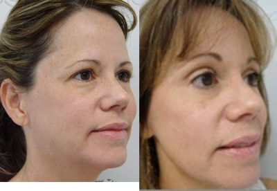 Brow Lift before and after photo