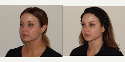 IPL before and after photo