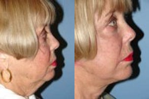 Lower Facelift before and after photo