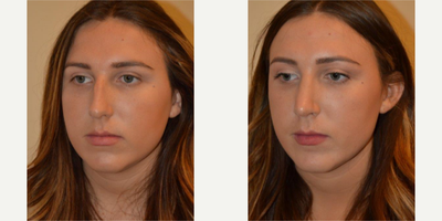 Rhinoplasty before and after photo