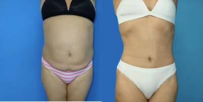 Tummy Tuck before and after photo