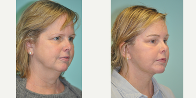 Brow Lift before and after photo