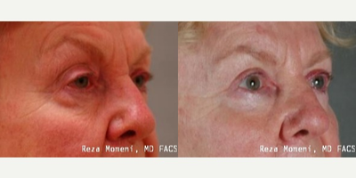 Eyelid Surgery before and after photo