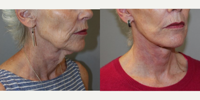 Facelift before and after photo