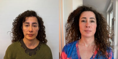 Facelift before and after photo