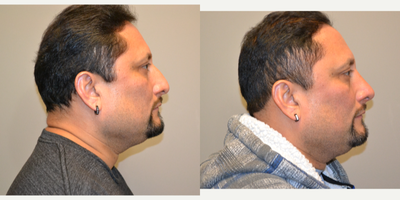 Rhinoplasty before and after photo