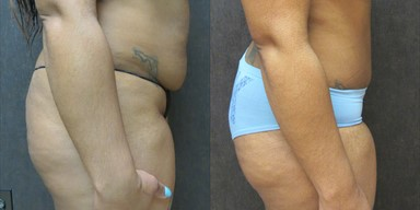 Tummy Tuck before and after photo