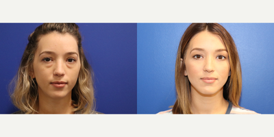 Eyelid Surgery before and after photo