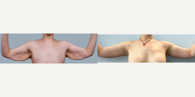 Arm Lift before and after photo