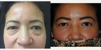 Eyelid Surgery before and after photo