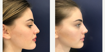 Nonsurgical Nose Job before and after photo