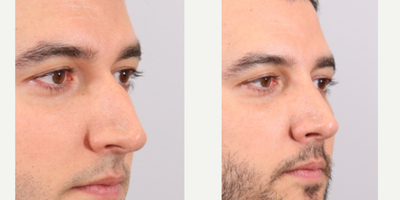 Rhinoplasty before and after photo