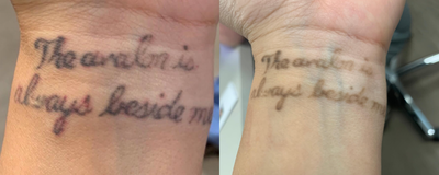 Tattoo Removal before and after photo