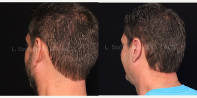Ear Surgery before and after photo