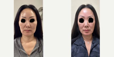 Emface before and after photo