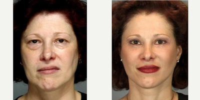 Facelift before and after photo