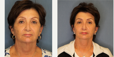 Facelift before and after photo