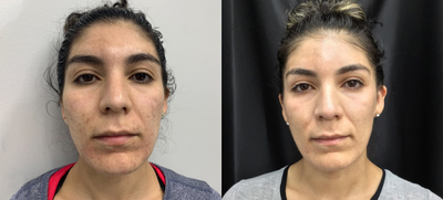 Facial before and after photo