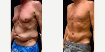 Liposuction before and after photo