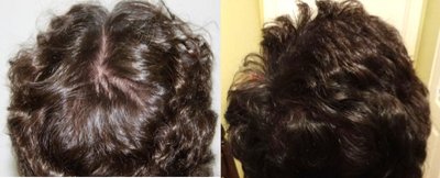 PRP for Hair Loss before and after photo