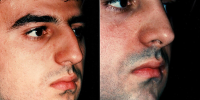 Rhinoplasty before and after photo
