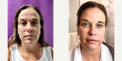 Botox before and after photo