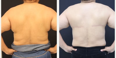 Breast Reconstruction before and after photo