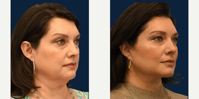 Buccal Fat Removal before and after photo