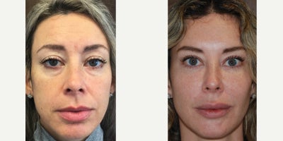 Dermal Fillers before and after photo