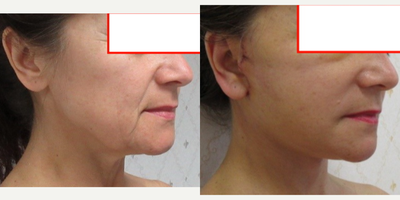 Facelift before and after photo