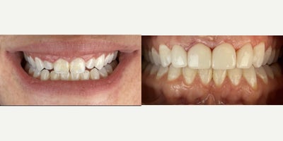 Porcelain Veneers before and after photo