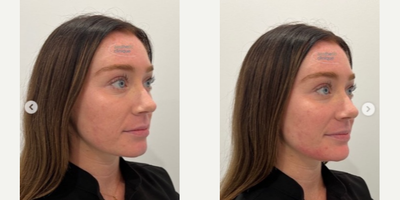 Restylane Defyne before and after photo