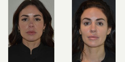 Revision Rhinoplasty before and after photo