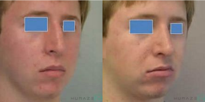 Rhinoplasty before and after photo
