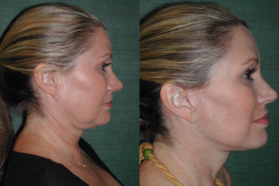 SMAS Facelift before and after photo