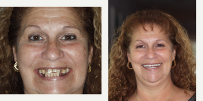 All-on-4 Dental Implants before and after photo