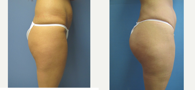 Butt Lift before and after photo